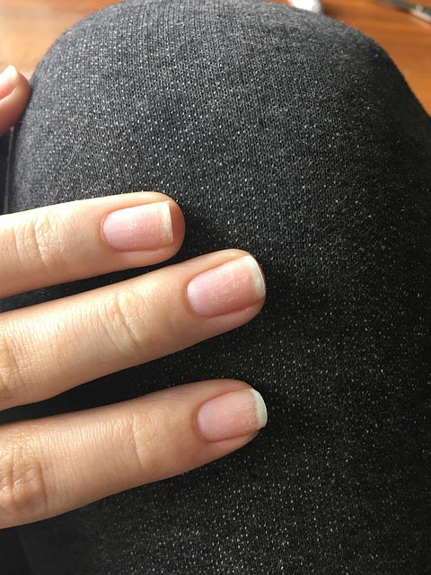 White spots on nails: myth or danger